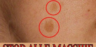 macchie cutanee specialmag.it